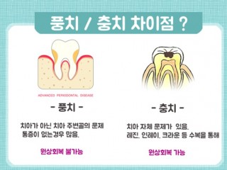 잇몸 붓고 피나고… 치아 흔들리고…