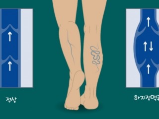 돌출심한 ‘푸른 힘줄’ 방치하면 병된다