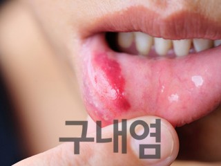 구내염, 입안에 생기는 모든 질병