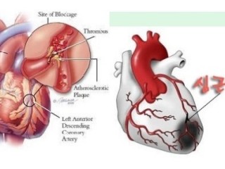 심근경색