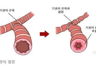 기관지 천식, 감기 예방이 무엇보다 중요