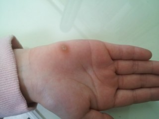 티눈과 사마귀, 발에 꼭 끼는 신발은 ‘티눈’ 유발 가능성