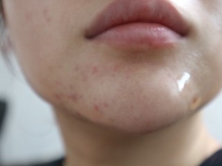 피부트러블 - 최신치료법 "효과 좋아졌지만 맹신은 금물"