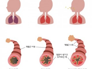 천식에 좋은 "행길탕"