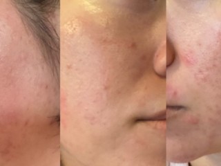 여드름 - 느릅껍질로 다스리자