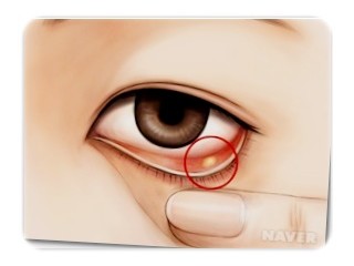 눈에 다래끼가 났을때