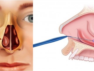 코막힘, 수술받아야...