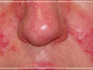 빨간볼에 딸기코…모세혈관 확장 탓