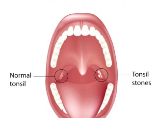편도선염에 걸렸을 때