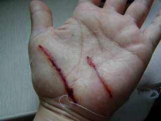 손바닥 상처