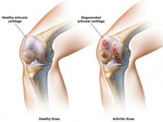 관절염 치료에 고양이 고기가 좋다?