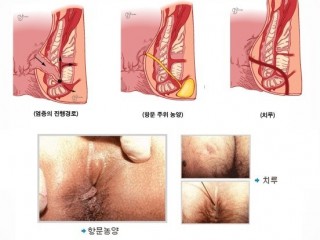 항문 - 온수로 자주 씻고 건조상태 유지하라