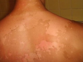 일광화상 처치법