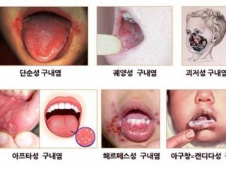 각종 입병의 원인과 예방법