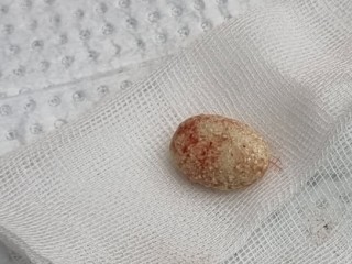 결석, 몸속 '돌멩이' 당신을 노린다