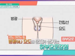 오줌소태…물 많이 마시면 예방효과