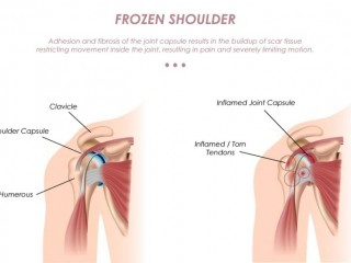 어깨통증, 이른바‘오십견’이란 병증