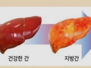 지방간, 적게 먹고 운동해야