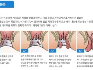 내색하기 곤란한 치질 완전히 뿌리뽑기