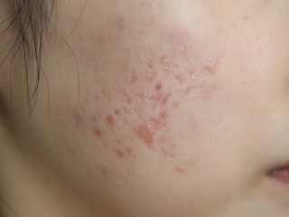 여드름의 원인과 치료