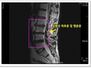 허리통증…척추증