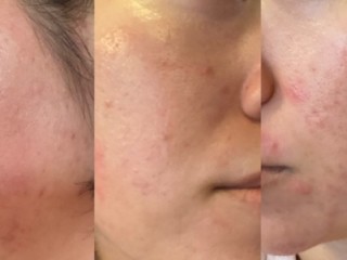 얼굴에 여드름이 심하게 돋으면.....