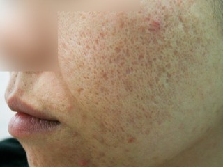 건강수첩-여드름과 흉터