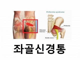 좌골신경통, 디스크와 좌골신경 문제 등 2가지 원인