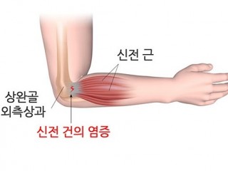 테니스-골프 칠때 잘 걸리는 "테니스 엘보"병