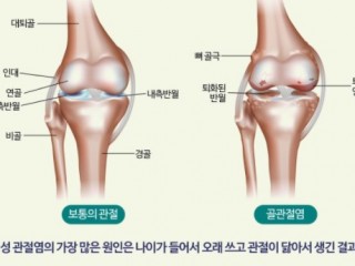 퇴행성관절염, 걷기 즐기고 등산 삼가야