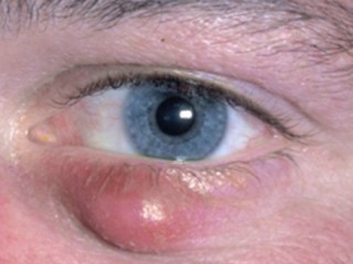 다래끼 - '은백혈' 따면 즉효