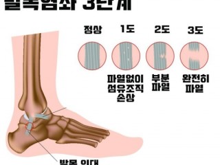 발목관절염좌