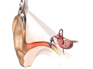 귀에 "인공마이크" 달면 난청환자도 "들리네"