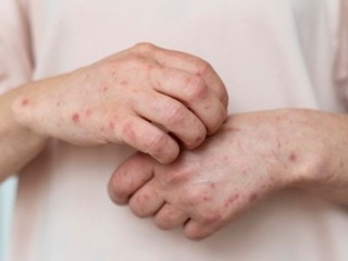 환절기 아토피 피부염