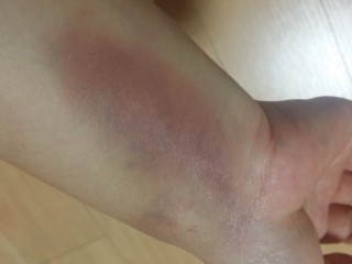 '시퍼런 멍' - 당귀, 꿀 먹으면 완화