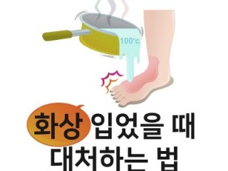 화상을 입었을 때